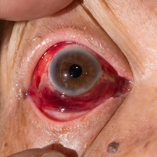 subconjunctival hemorrhage at eye test - Photo, Image