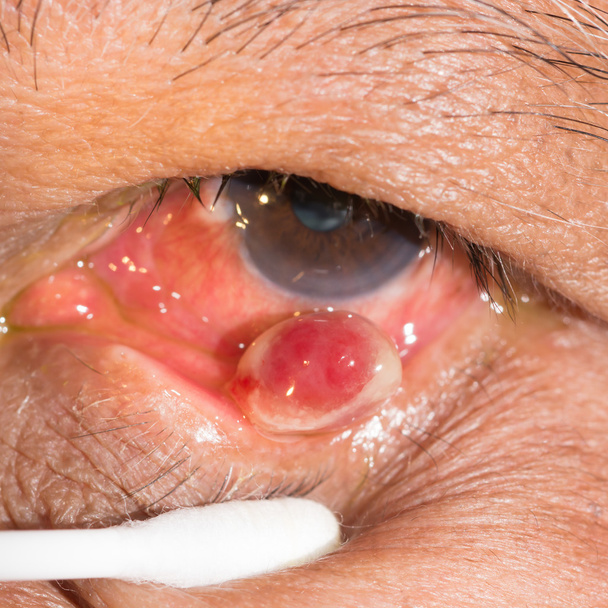  Granuloma piogénico en la prueba ocular
 - Foto, imagen