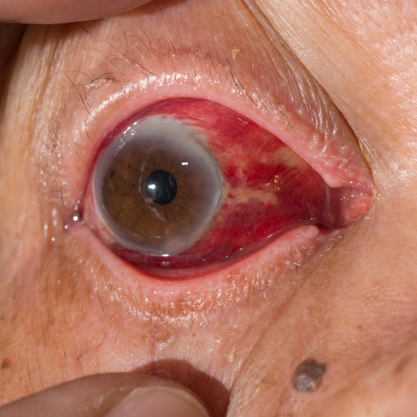 subconjunctival hemorrhage at eye test - Photo, Image