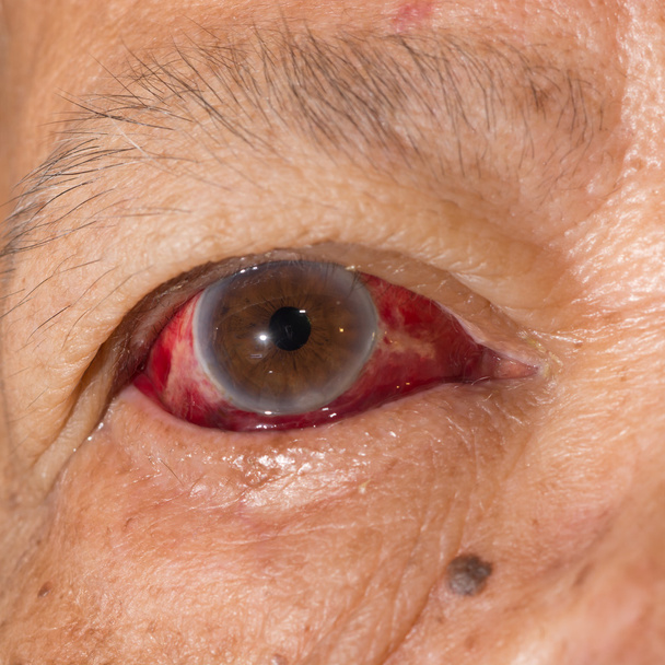 hemorragia subconjuntival en la prueba ocular
 - Foto, Imagen