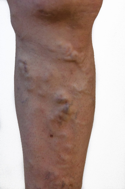 Varicose veins on a leg. - Photo, Image