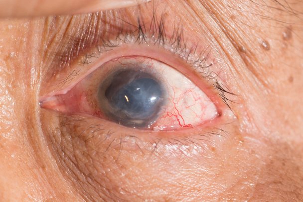 phthisis bulbi at eye test - Photo, Image