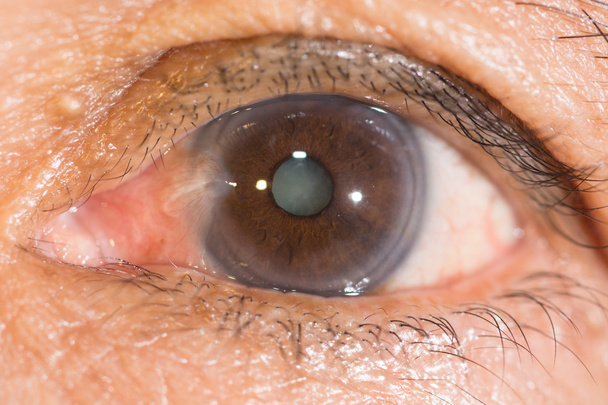 ptérygium et cataracte sénile au test oculaire
 - Photo, image