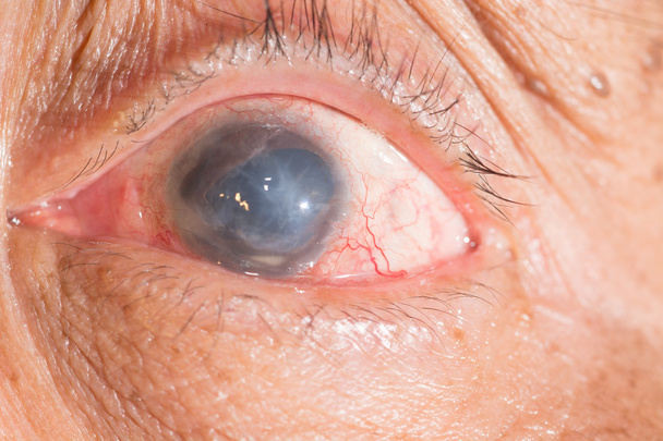 phthisis bulbi göz testi - Fotoğraf, Görsel