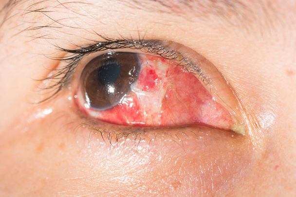Иссечение птеригия при проверке зрения
 - Фото, изображение