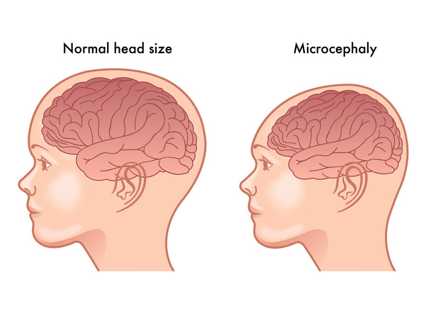 Illustration der Symptome der Mikrozephalie - Vektor, Bild