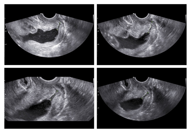 Коллаж медицинских изображений УЗИ во время сканирования аномалий показывает
 - Фото, изображение