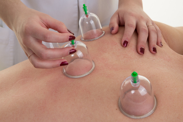 Akupunktura terapeuta kobieta usuwanie Puchar z tyłu pacjentki - Zdjęcie, obraz