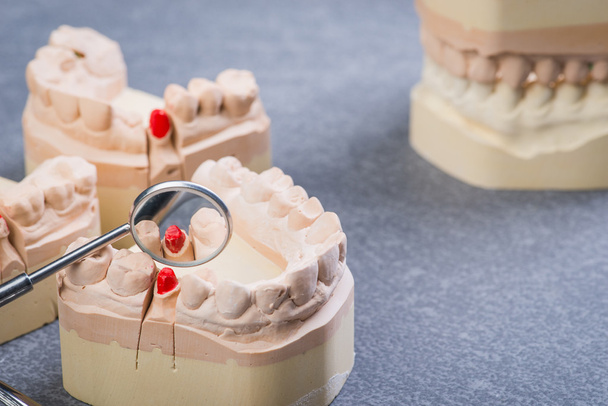 Molde de dientes con espejo bucal
 - Foto, Imagen