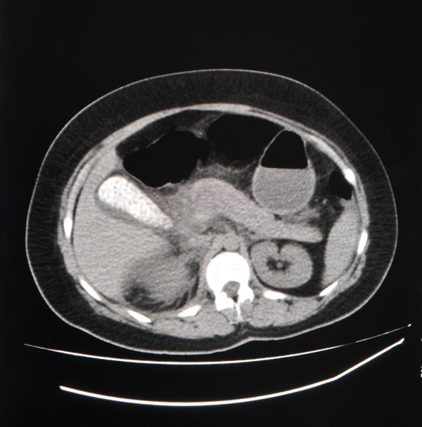 TAC de abdomen - Foto, Imagen