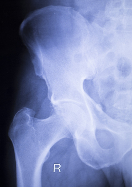Lonkkanivel kirurginen implantti röntgenkuvaus
 - Valokuva, kuva