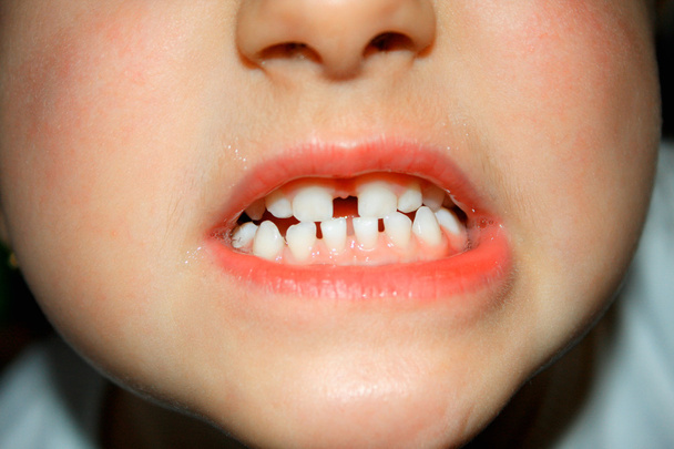 Le grand espacement entre les dents dans la bouche des garçons
 - Photo, image