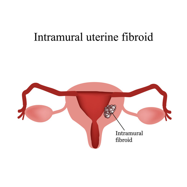 Intramural uterine fibroids. Endometriosis. Infographics. Vector illustration isolated on white background - Vector, Image