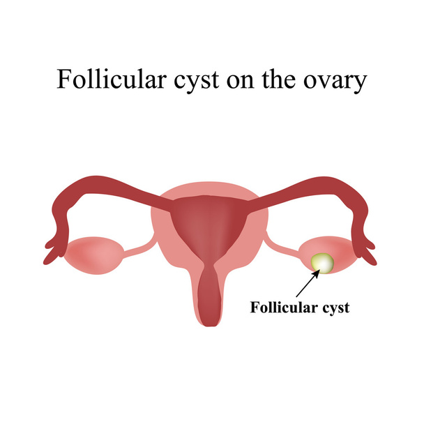 Kyste ovarien folliculaire. Kyste fonctionnel. Infographie. Illustration vectorielle sur fond isolé
 - Vecteur, image