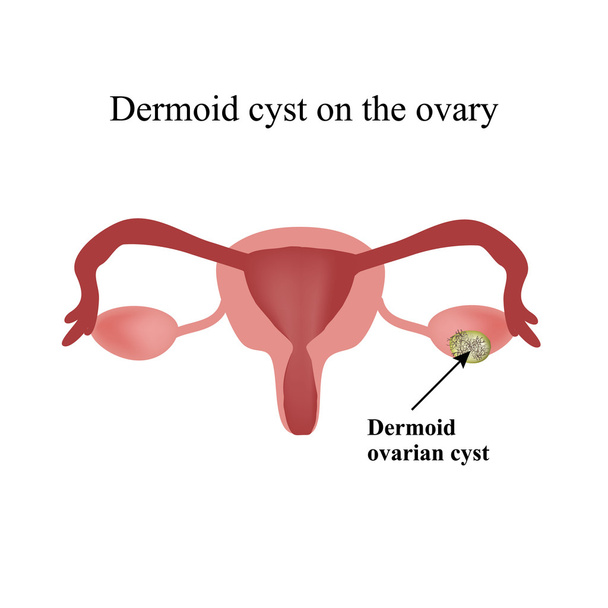 Quiste dermoide en el ovario. Ovario. Infografías. Ilustración vectorial sobre fondo aislado
 - Vector, imagen