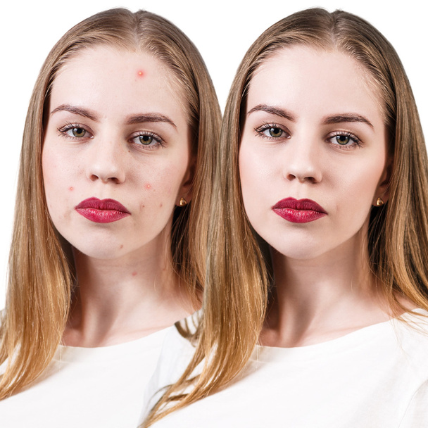Žena s problémem kůže na tváři - Fotografie, Obrázek