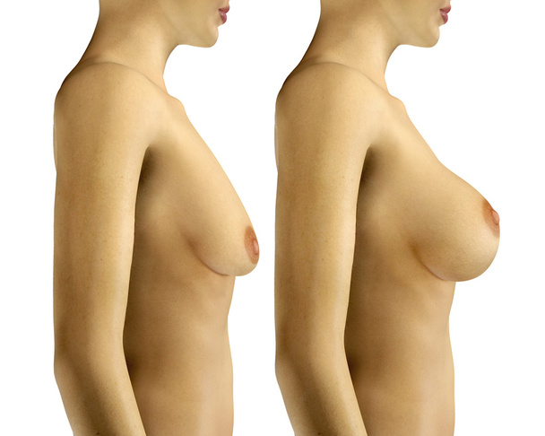 3d illustration Breast Enlargement with Uplift surgery  before a - Foto, afbeelding