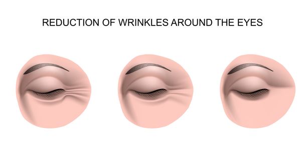 wrinkles around the eyes - Vector, Image