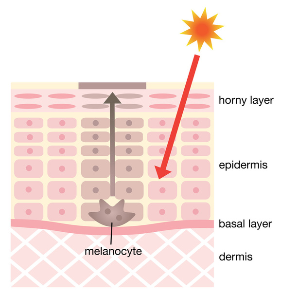 ilustração infográfica da pele. mecanismo de pele de manchas faciais
 - Vetor, Imagem