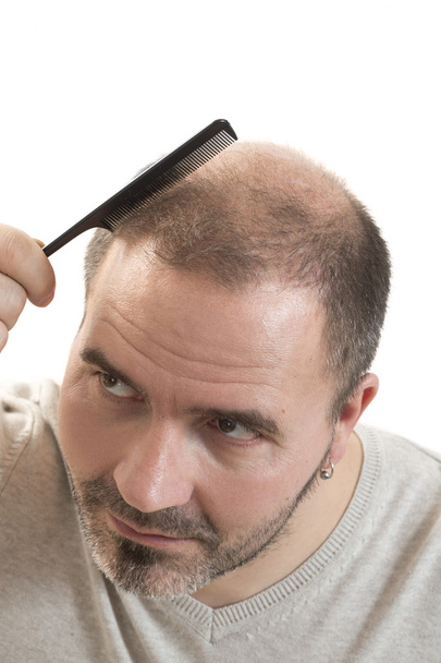 man alopecia baldness hair loss isolated - Foto, Bild