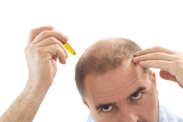 man alopecia baldness hair loss isolated - Photo, Image