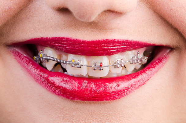 Woman with brackets - Photo, Image