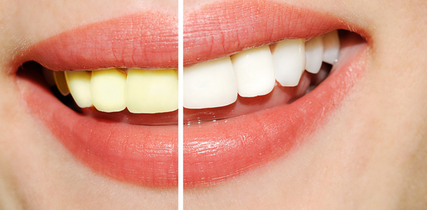 Frauenzähne vor und nach dem Bleaching - Foto, Bild