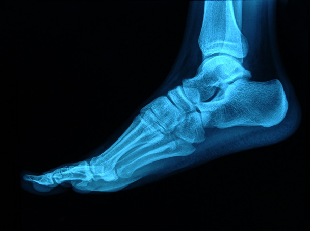 Raggi X del piede
 - Foto, immagini
