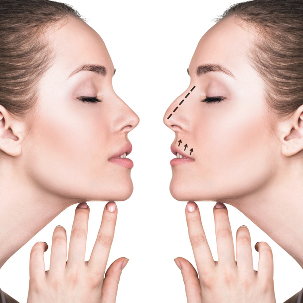 Женское лицо до и после косметической операции на носу
 - Фото, изображение