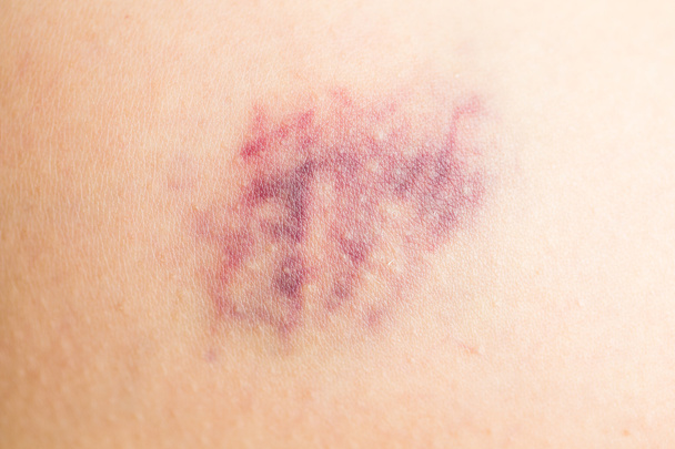 Bruise on wounded skin - Photo, Image