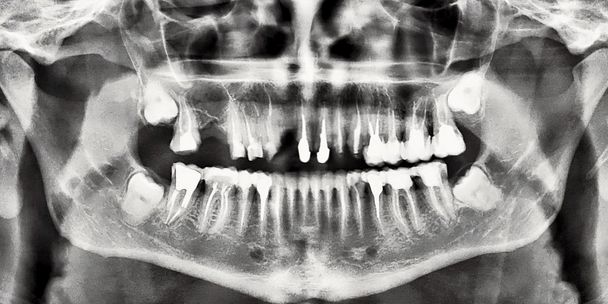 raio-x dos dentes
 - Foto, Imagem