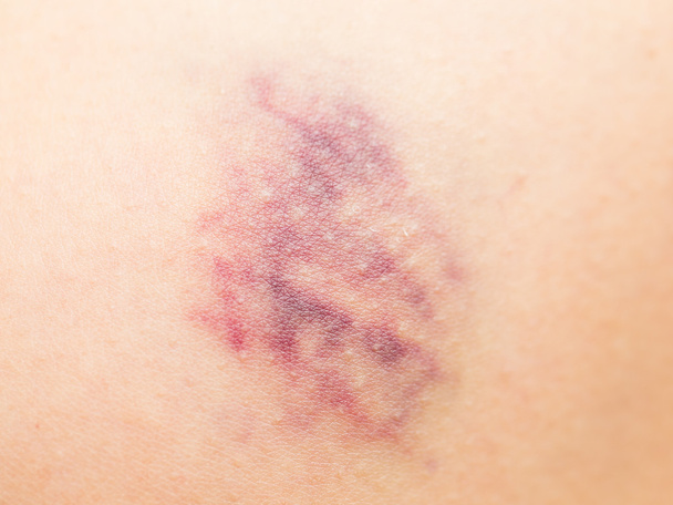 Bruise on wounded skin - Photo, Image