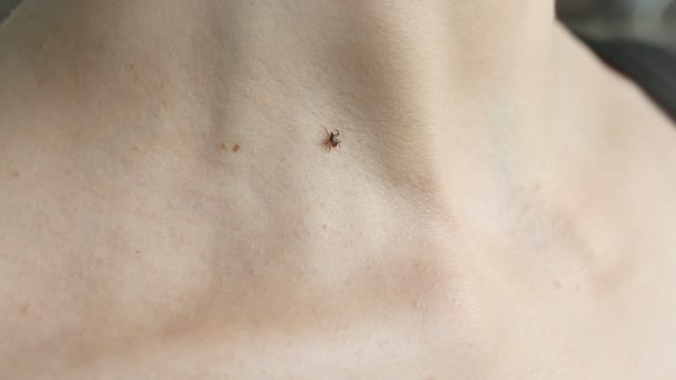 Tick crawling on human Skin - Footage, Video