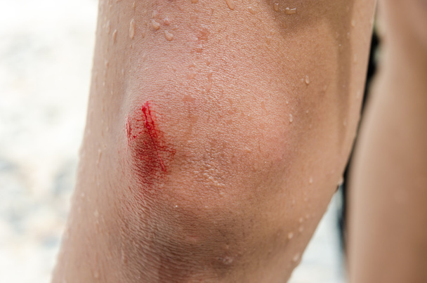 Bloody bruise wound on the knee - Photo, Image
