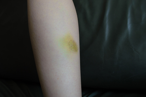 Μελανιασμένο δέρμα, ένα πόδι με πόνο - Φωτογραφία, εικόνα