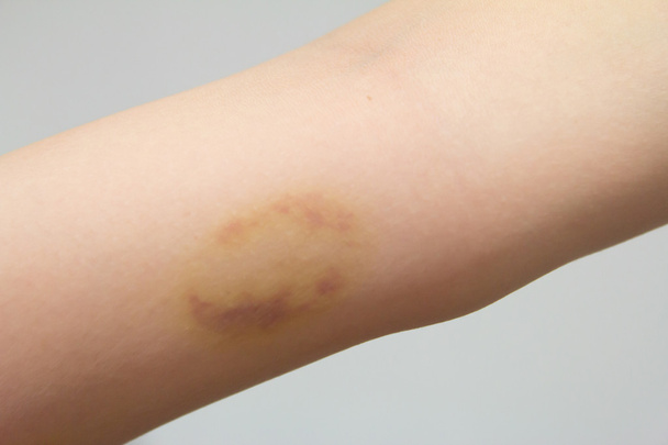 Prellungen am verletzten weiblichen Arm - Foto, Bild