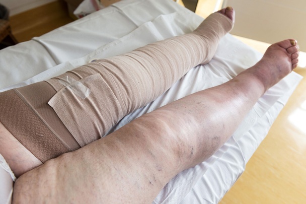 Bandaged patient's legs - Foto, afbeelding