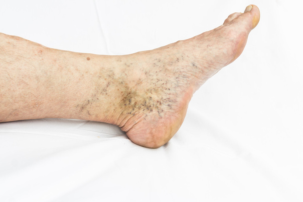 varices sur la jambe gauche
 - Photo, image