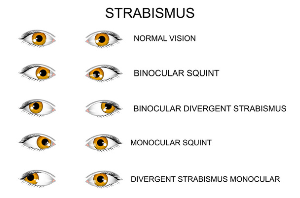 oči. typy strabismus - Vektor, obrázek
