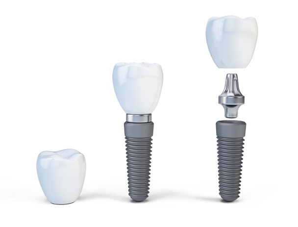 Zubní lidské implantát izolovaných na bílém. 3D vykreslování - Fotografie, Obrázek