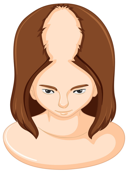 Perte de cheveux sur la tête féminine
 - Vecteur, image