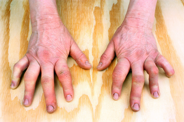 Рука ревматоидного артрита
 - Фото, изображение