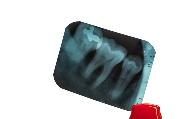 Zähne und überlappende Zähne im Röntgenfilm zeigen und Pinzette auf - Foto, Bild