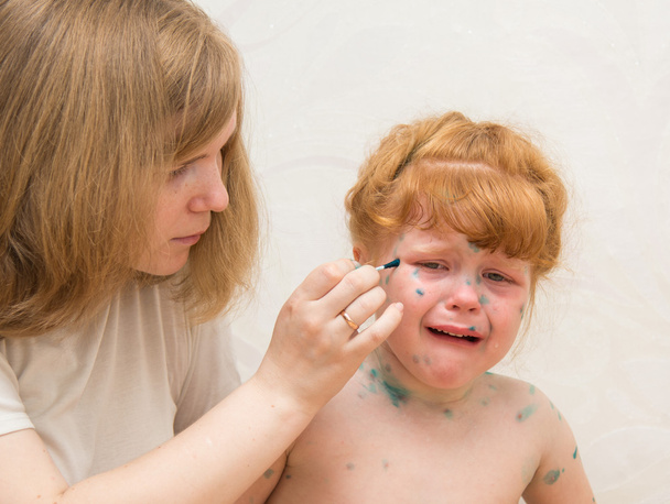 Little girl mom lubricates the cure for chicken pox - Foto, immagini