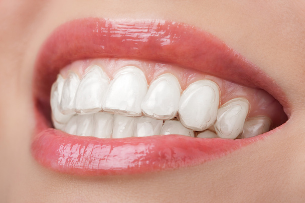 teeth with whitening tray smile dental - Фото, зображення