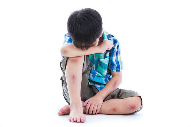 Young boy covering his face. According to the body with wounds contusion. Isolate on white background. - 写真・画像