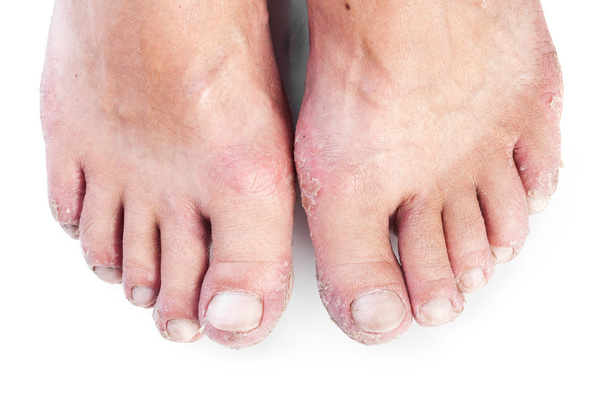 Dos pies masculinos con eczema aislado sobre fondo blanco
 - Foto, imagen