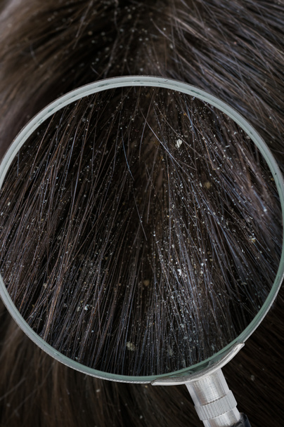 Examiming płatki białe łupieżu włosów z lupy. - Zdjęcie, obraz