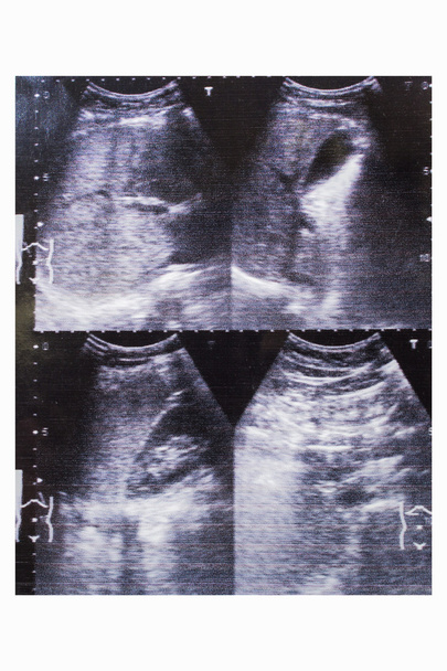 ultrasound picture printed of gallbladder, liver inflammation of - Photo, Image