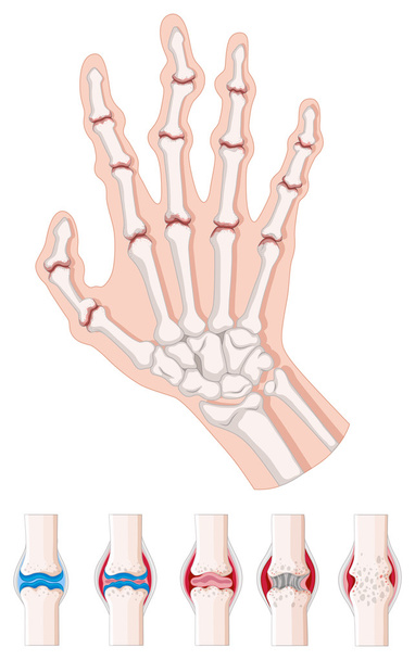 Rheumatoid arthritis diagram fehér - Vektor, kép